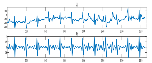 Baseline Wander Noise