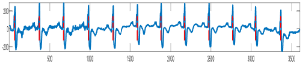 Baseline Wander Noise