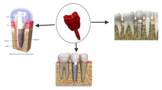 Artificial Tooth Forming